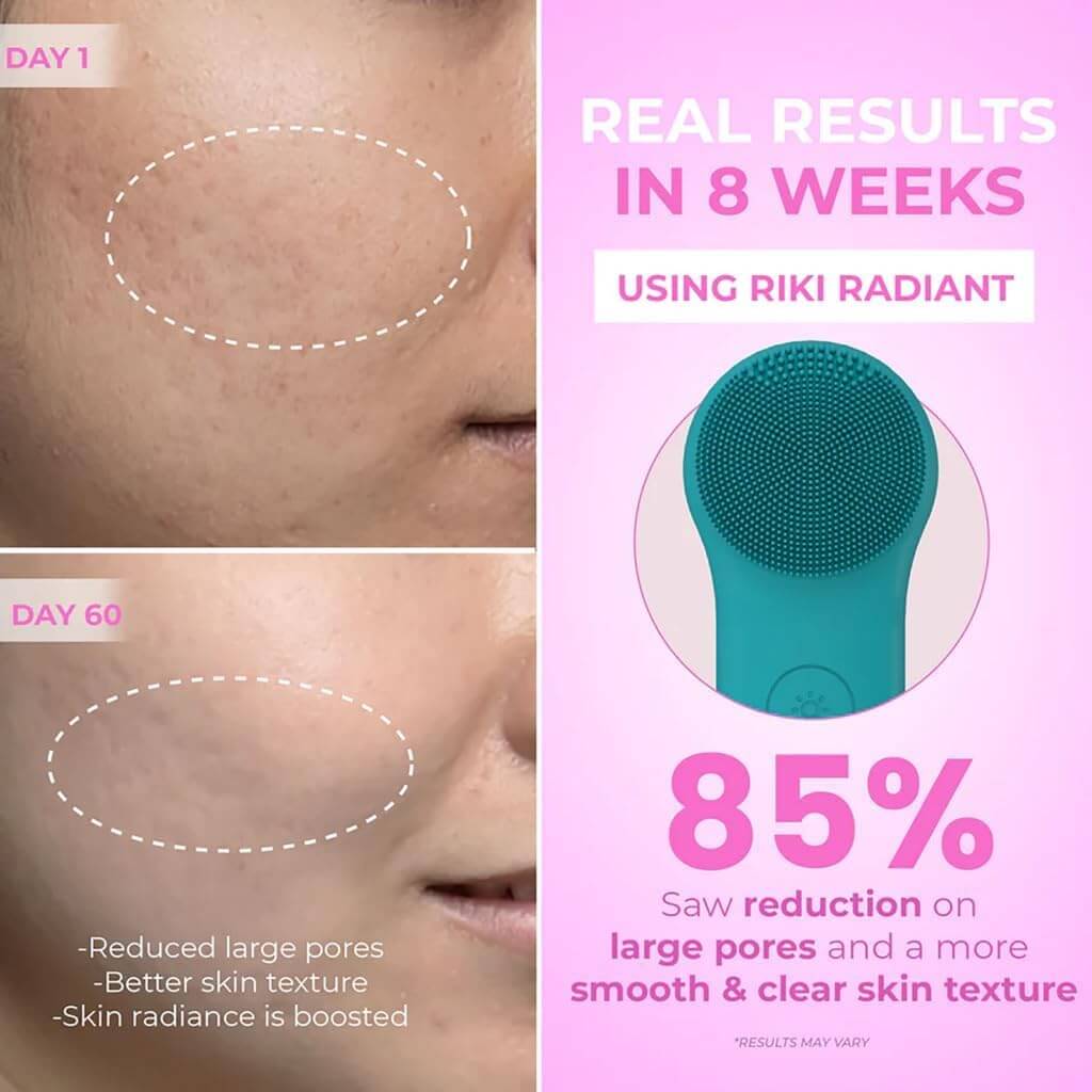 Voor-en-na afbeelding van huidverandering met Jovyx 2-in-1 Elektrische Silicone Gezichtsontstopper na 8 weken gebruik.